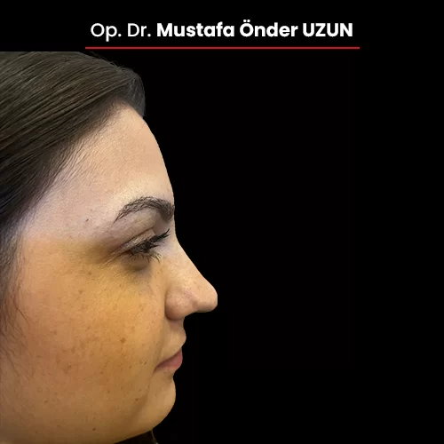 Öncesi Sonrası 1301601917