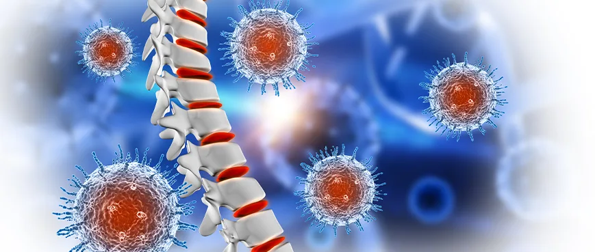 ТУМОРИ НА КОСТИТЕ И МЕКИТЕ ТЪКАНИ: СИМПТОМИ, ДИАГНОСТИКА И ЛЕЧЕНИЕ