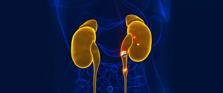 Всичко от А до Я за камъните в бъбреците
