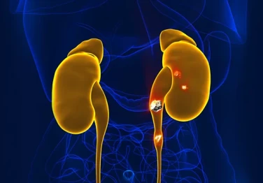 Всичко от А до Я за камъните в бъбреците