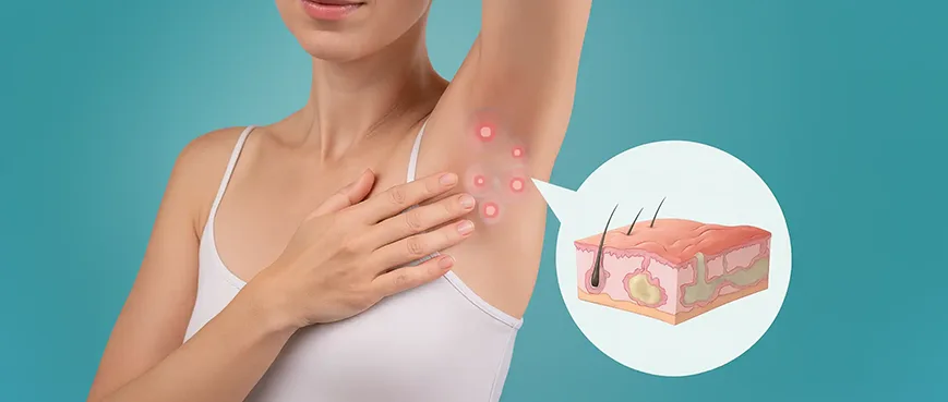 Гноен Хидраденит ( Хидраденит Супуратива) – диагнозата, симптоми и лечение