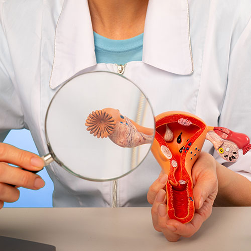 Рак на яйчниците