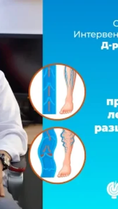 Разширени вени – причини, симптоми и как да се справим